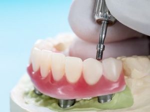 Prótesis sobre Implantes Dentales en Torrejón de Ardoz